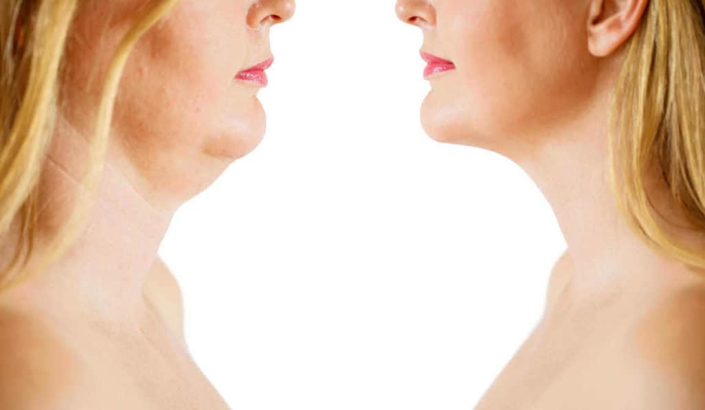 Double Chin treatment Billericay before and after results