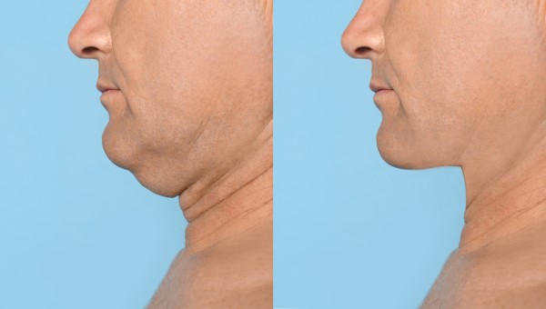 Which Non-Surgical Treatments Work Best for Jowls and Loose Skin Billericay?