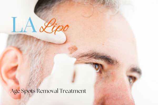 What Are the Most Effective Treatments for Age Spots Billericay?