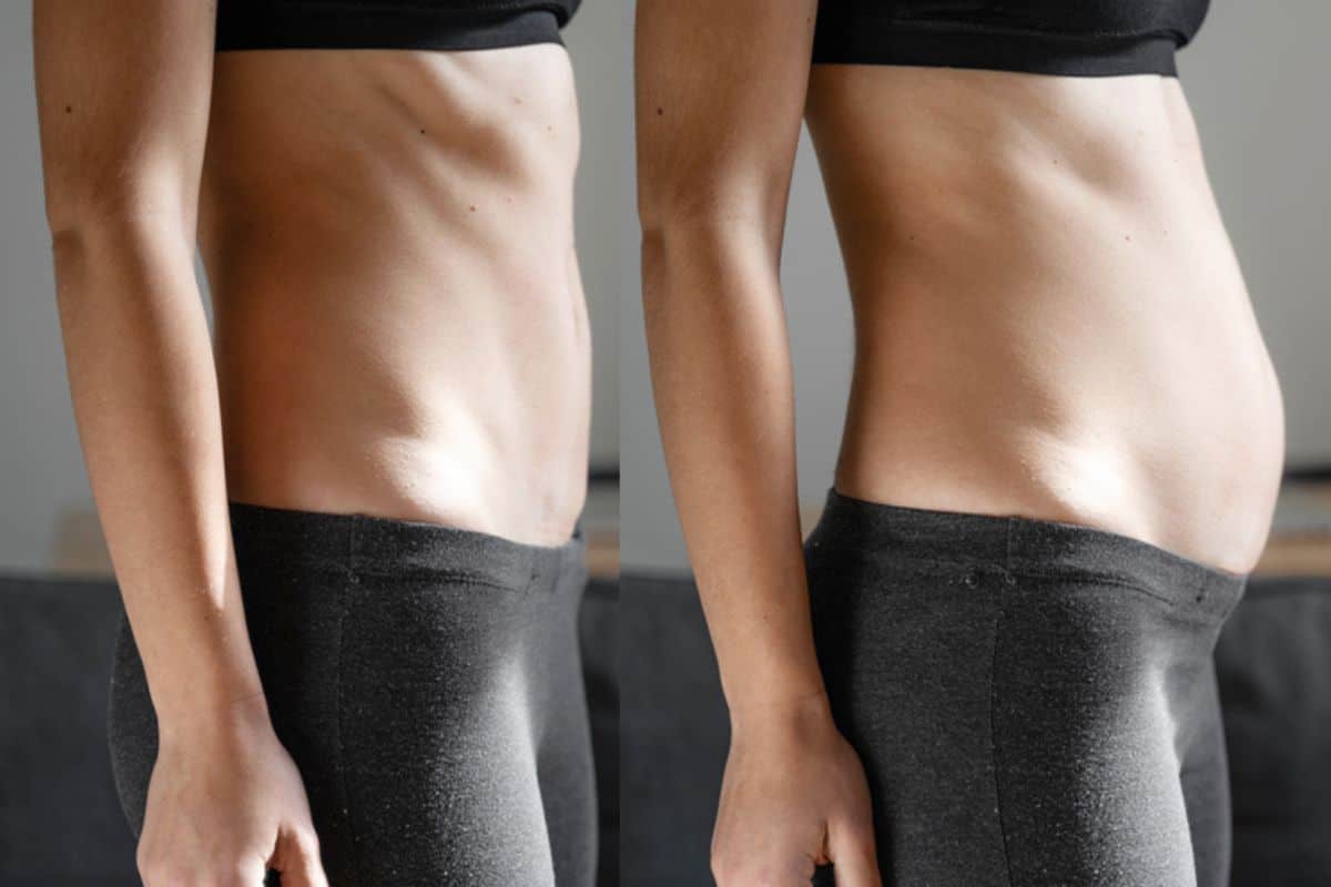 How long does diastasis recti take to improve Billericay?