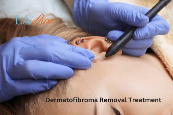 Dermatofibroma Removal Treatment Billericay