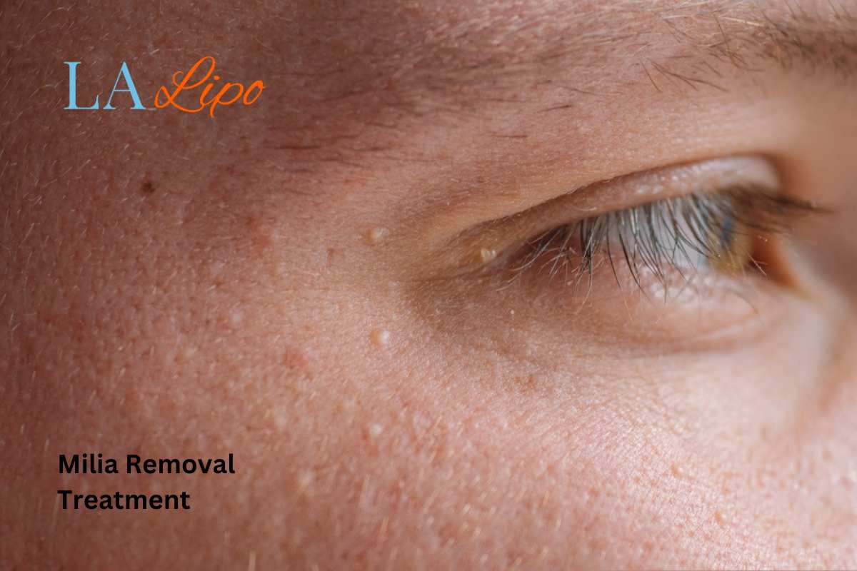 Cryopen Milia Removal: Is It the Easiest and Safest Option Billericay?