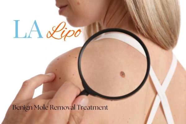 Why getting moles removed Billericay can boost your confidence!