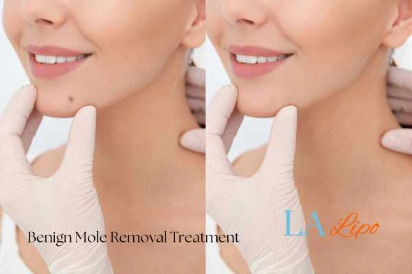 Woman's before and after results of being moles removal treatment Billericay