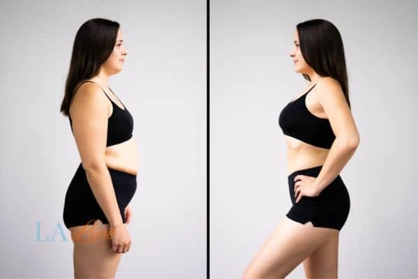 LA-EMS Body Sculpting Billericay results before and after of womans results on body toning.