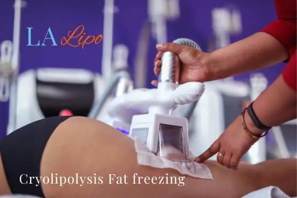 women getting fat freezing Billericay