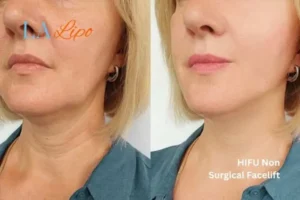 hi-fu for wrinkles Billericay before and after results