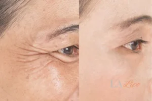 Before and after results of woman - HI-fu wrinkles reduction treatment Billericay