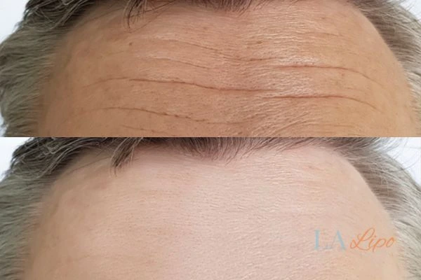 results of HIFU Billericay on mans forehead to help reduce lines and wrinkles