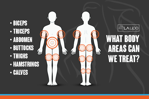 Graphic to show areas you can have LA-EMS Body Sculpting Billericay treatment.