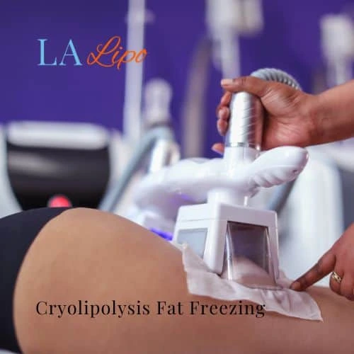 fat freezing - Cryolipolysis Billericay