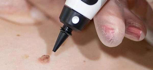 skin tag removal using cryopen Billericay
