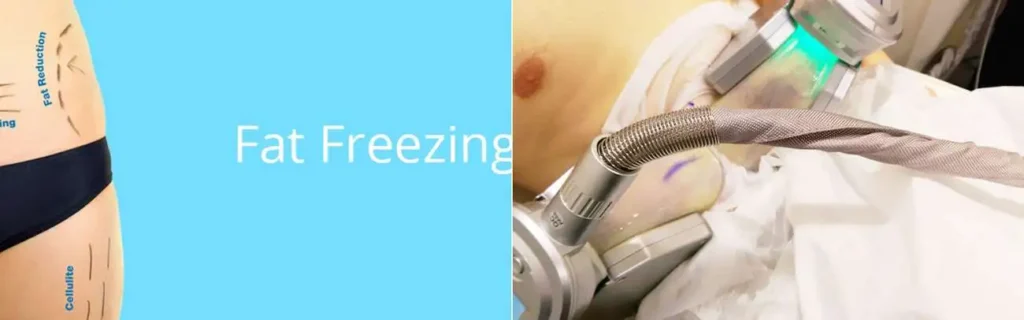 Fat freezing Billericay on multiple areas of the body