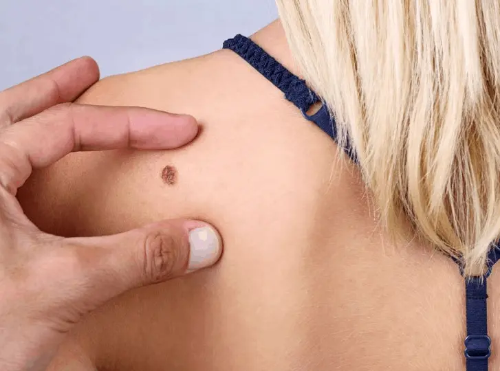 woman having mole removal Billericay consultation before treatment.