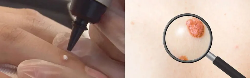 Cryopen for mole removal Billericay - speak to our team today!
