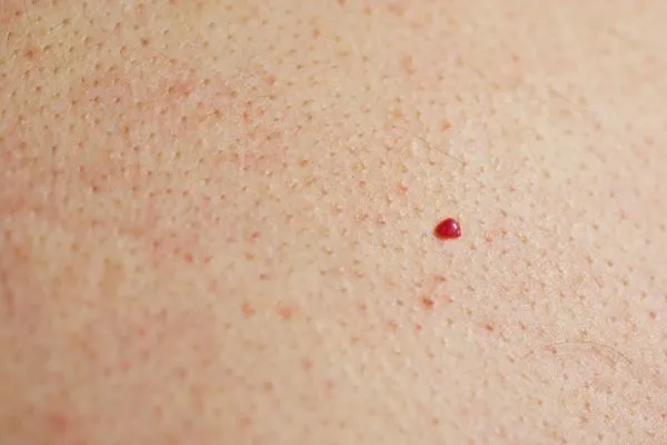 close up of a cherry angioma Billericay