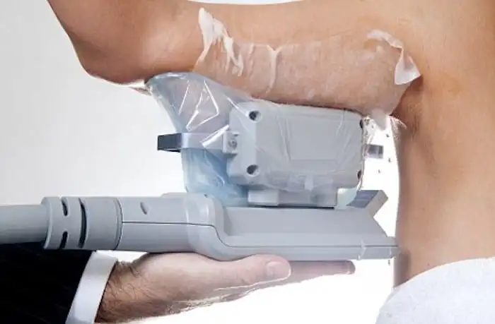 Picture of fat freezing Billericay on the upper arms.