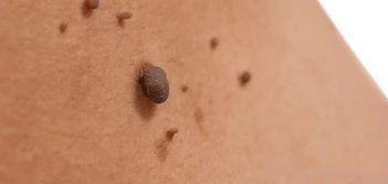 image of a skin tag Billericay
