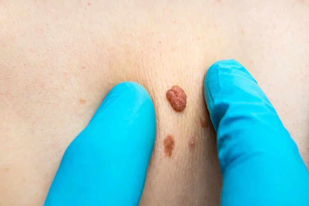 Consultant examining a skin tag Billericay