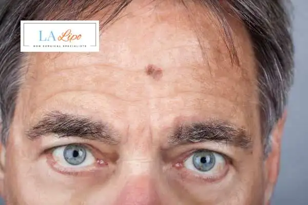 Solar Lentigo Removal Billericay image of man with mark on his forehead