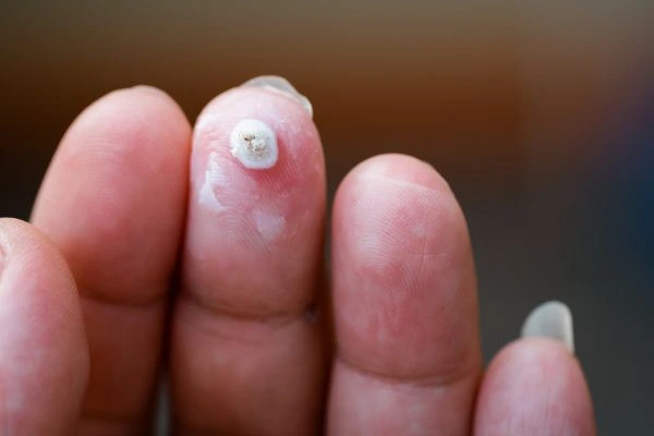 wart on person finger - cryotherapy to treat from LA LIPO Billericay