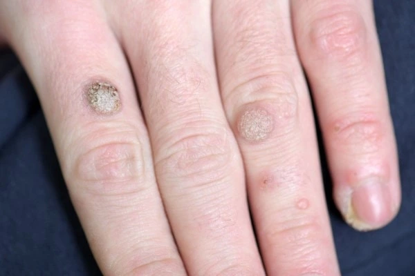 photo of warts on person hand - see wart removal Billericay from LA LIPO