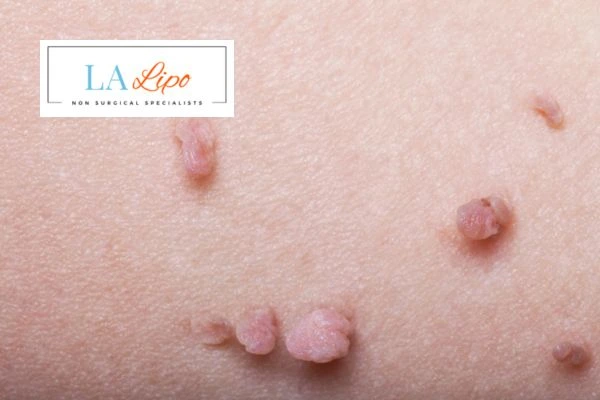 Does cryopen skin tag removal Billericay hurt? Find out now call our team today!