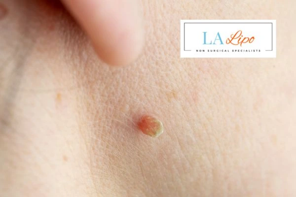 Book skin tag removal Billericay today speak to our team now!