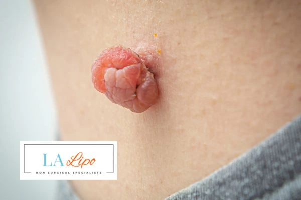 Interested in skin tag removal Billericay? Concerned about the pain? Find out more today!