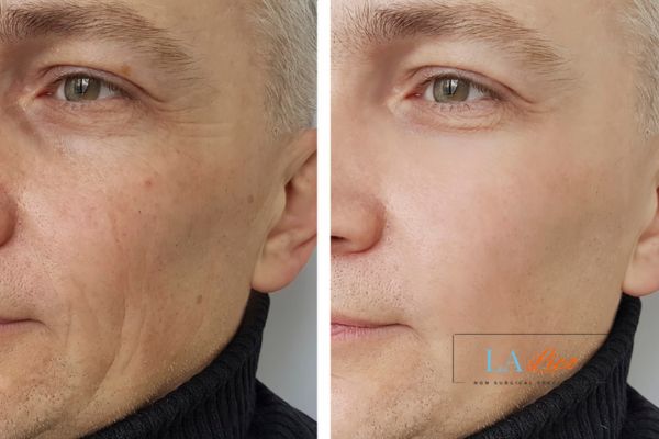 See the amazing results of Morpheus8 Treatment Billericay!