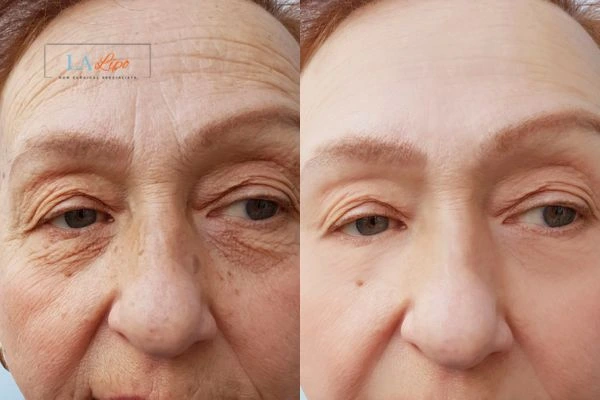 The powerful benefits of Morpheus8 Treatment Billericay - Call Our team today!