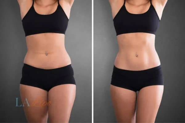 before and after results of non-surgical treatment to help a woman's body image and mental health Billericay
