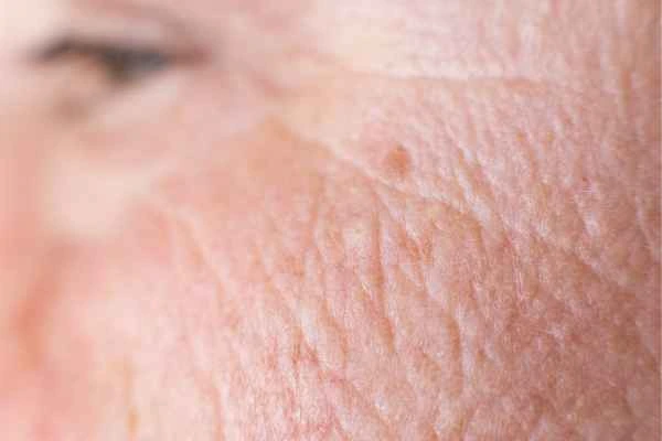 close up picture of a woman's face showing an age spot Billericay