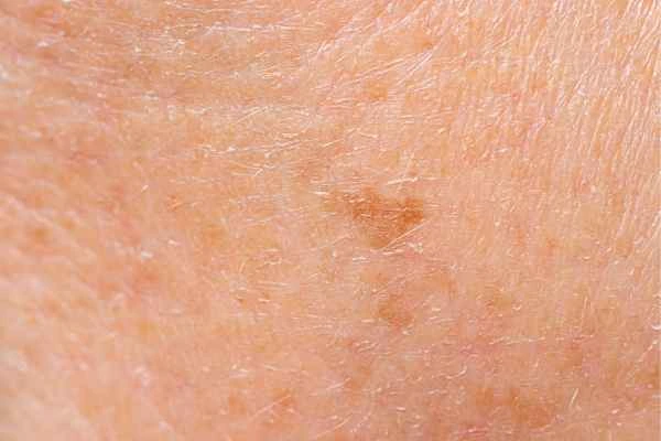 close up picture of age spots Billericay