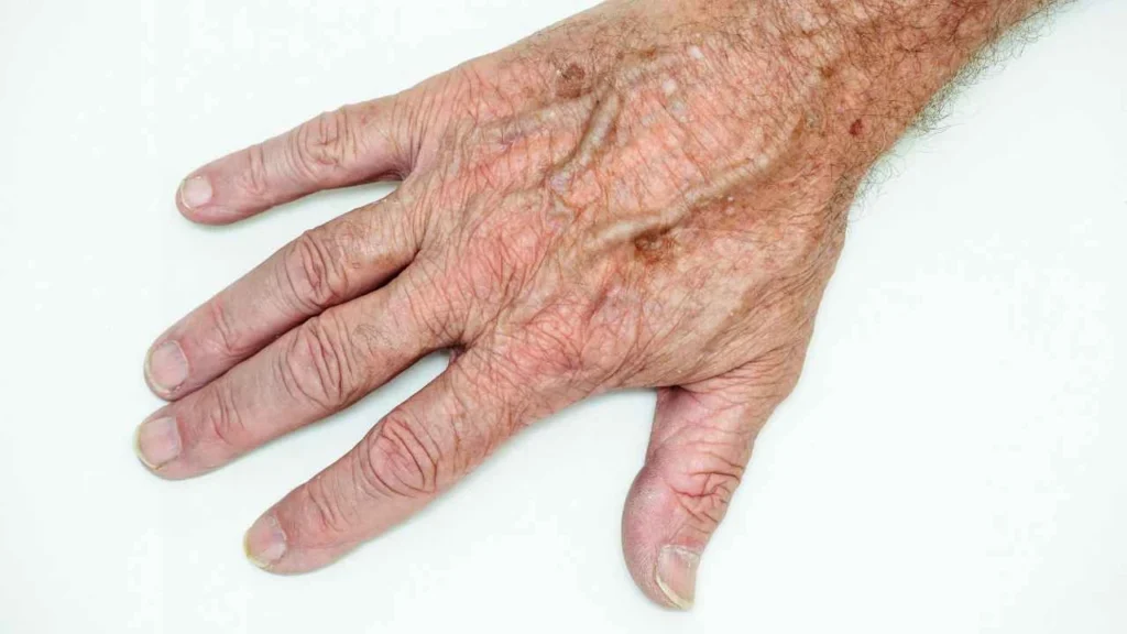 Male hand showing age spot Billericay