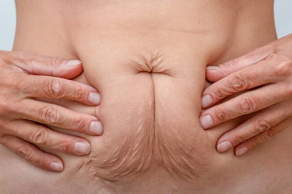 Image of a woman's stomach with loose skin - example of skin tightening Billericay options