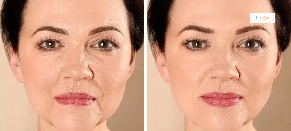 How Long Does It Take to See Results and How Long Do They Last Billericay?